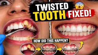 Thumbnail: Twisted Canine Correction 🦷 Rotated Tooth Straightening Process Step By Step