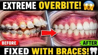 Thumbnail: Extreme Overbite Correction 😱 Crooked Teeth Transformed with Braces | Amazing Before & After