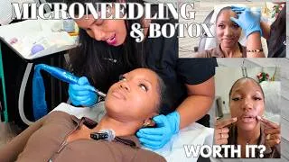 Thumbnail: I Got Botox + Microneedling 😅 Was It Worth It?