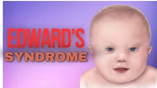 Thumbnail: Edwards Syndrome (Trisomy 18) Explained: Causes, Symptoms & Diagnosis |
