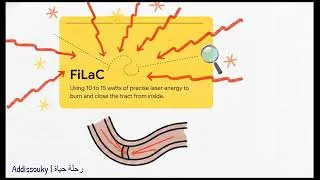 Thumbnail: AI, Lasers, and Stem Cells: The New Era of Anal Fistula Treatment