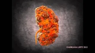 Thumbnail: Polycystic Kidney Animation