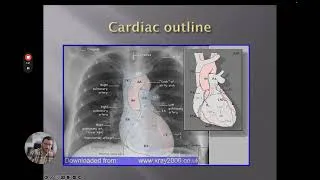 Thumbnail: Chest X-Rays - Understanding a Systematic Approach to Image Interpretation. Part 3 of 4