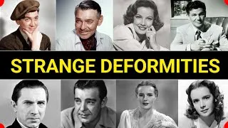 Thumbnail: 17 Classic Stars With Secret DISABILITIES and DEFORMITIES ... One Should Have Been So Obvious 
