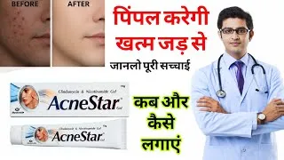 Thumbnail: Acnestar gel review 2026 review in hindi | how to use acnestar gel 