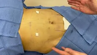 Thumbnail: Tummy Tuck Transformation with Dr. Akkary!