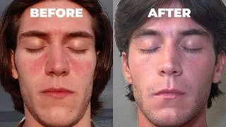 Thumbnail: How I Beat Seborrheic Dermatitis & Flaky Skin