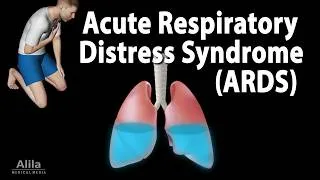 Thumbnail: Acute Respiratory Distress Syndrome (ARDS): Symptoms, Causes, Diagnosis and Treatment, Animation.