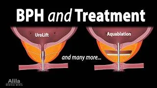 Thumbnail: BPH and Treatment Options (TURP, TUIP, EEP, HoLEP, PUL, UroLift, iTIND, Rezum, Aquablation and PAE)