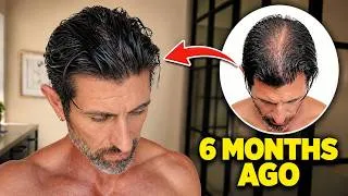Thumbnail: How I REVERSED My Hair Loss and Stopped Balding