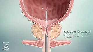 Thumbnail: Laborie Optilume BPH - 3D Medical Animation