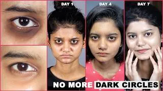 Thumbnail: Get Rid of DARK CIRCLES Naturally in 7 Days | Permanent Solution of Dark Circle | Remove Dark Circle