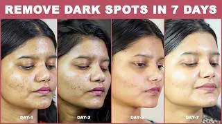 Thumbnail: Remove Dark SPOTS & Pimples MARKSPermanently in 7 DAYS | Remove Dark Spots & Pimple marks  naturally