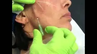 Thumbnail: The Fishbone Thread Lift – Why it’s the best PDO lifting solution.