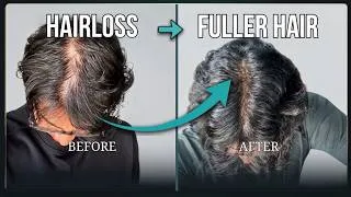 Thumbnail: Watch this, if you're losing Hair