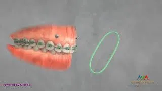 Thumbnail: Orthodontic Treatment for Gummy Smile - TAD and Elastics