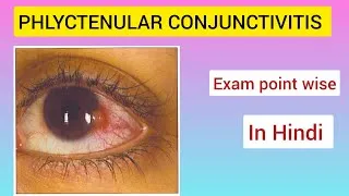 Thumbnail: |Phlyctenular conjunctivitis in hindi| #Ophthalmology #शालाक्यतंत्र #AYURVEDA 