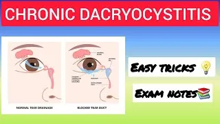 Thumbnail: |Chronic Dacryocystitis In hindi |#opthalmology #CDCR #aiapget #BAMS 