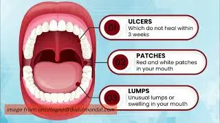 Thumbnail: Health Matters: Oropharyngeal Cancer