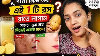 Thumbnail: 🥔 Potato Juice for Pigmentation | আলুর রস দিয়ে কালো দাগ ও Pigmentation কমানোর উপায় | DIY Skin Care