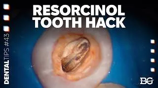 Thumbnail: Endo access hack: using phosphoric acid to clean discolored pulp chambers