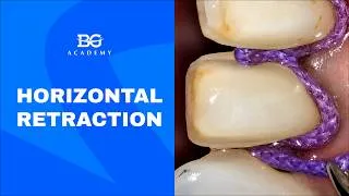 Thumbnail: Tissue management: horizontal retraction protocol