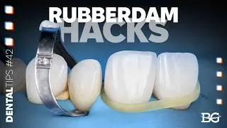 Thumbnail: Rubberdam bonding hack: 3 ways to manage tight contacts with veneers
