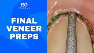 Thumbnail: Final veneer preps