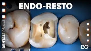 Thumbnail: Endodontic workflow hack: why you should take an impression before RCT