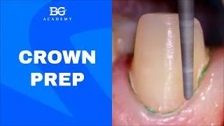 Thumbnail: Crown prep of a canine: step by step