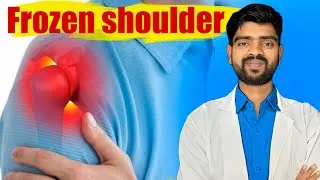 Thumbnail: Frozen shoulder 
