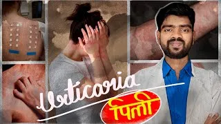 Thumbnail: Urticaria | पित्ती | pitti | Best Medical Lecture Hindi 