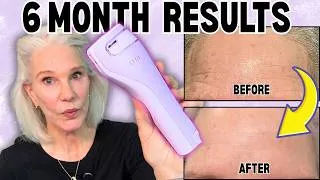 Thumbnail: I Tried the TRIA Fractional Home Laser for 6 Months: Worth The 💰Money?