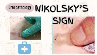 Thumbnail: Nikolsky's sign|understanding terms in dentistry|oral pathology|#dental #oralpathology #video #exams