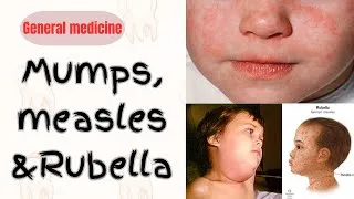 Thumbnail: Mumps|Measles|Rubella|MMR vaccine|koplik's spot#dental #medicine #surgeryday  #bds #mmr #vaccine