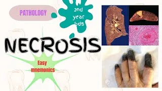 Thumbnail: Necrosis|General pathology|2nd year bds|Essay|#mnemonics#dental #dentalstudies #bds #essay #easy