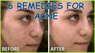 Thumbnail: How to Clear up Acne - 6 Natural Remedies For Acne