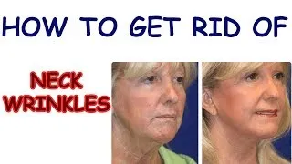 Thumbnail: How To Get Rid Of Neck Wrinkles, Homeopathically - 6 NATURAL HOME REMEDIES FOR WRINKLES