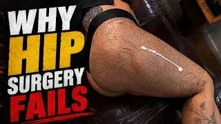 Thumbnail: Why Your Hip Still Hurts After Surgery (Micro-instability)