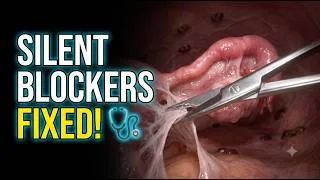 Thumbnail: How Operative Laparoscopy Instantly Cures Silent Infertility Blockers! 🔬