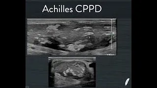 Thumbnail: Achilles CPPD