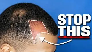 Thumbnail: Do natural products ACTUALLY work for hairloss? (Science explains)