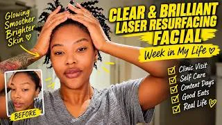 Thumbnail: CLEAR + BRILLIANT Laser Facial on Black Skin | Laser Resurfacing, Skincare & Living Alone Diaries