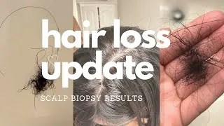 Thumbnail: HAIR-LOSS UPDATE: Emotional Scalp Biopsy results Androgenetic Alopecia