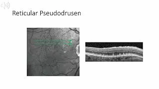 Thumbnail: Retina Chapter 4: Age Related Macular Degeneration and Other Causes of CNV