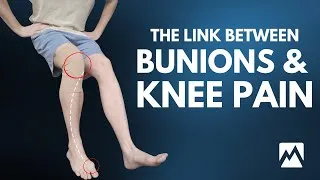 Thumbnail: The Link Between Knee Pain & Bunions