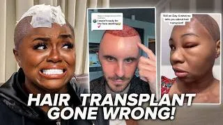 Thumbnail: Hair Transplant Gone WRONG‼️ *REACTION*