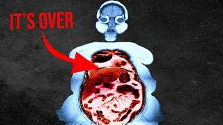 Thumbnail: A woman took a friend's Ozempic and her entire gut was cooked