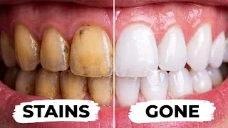Thumbnail: Whitening Strips Are Designed To Fail — Here Is What Keeps Teeth White Forever!