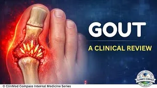 Thumbnail: Gout: From Hyperuricemia to Tophi – A Concise Clinical Review